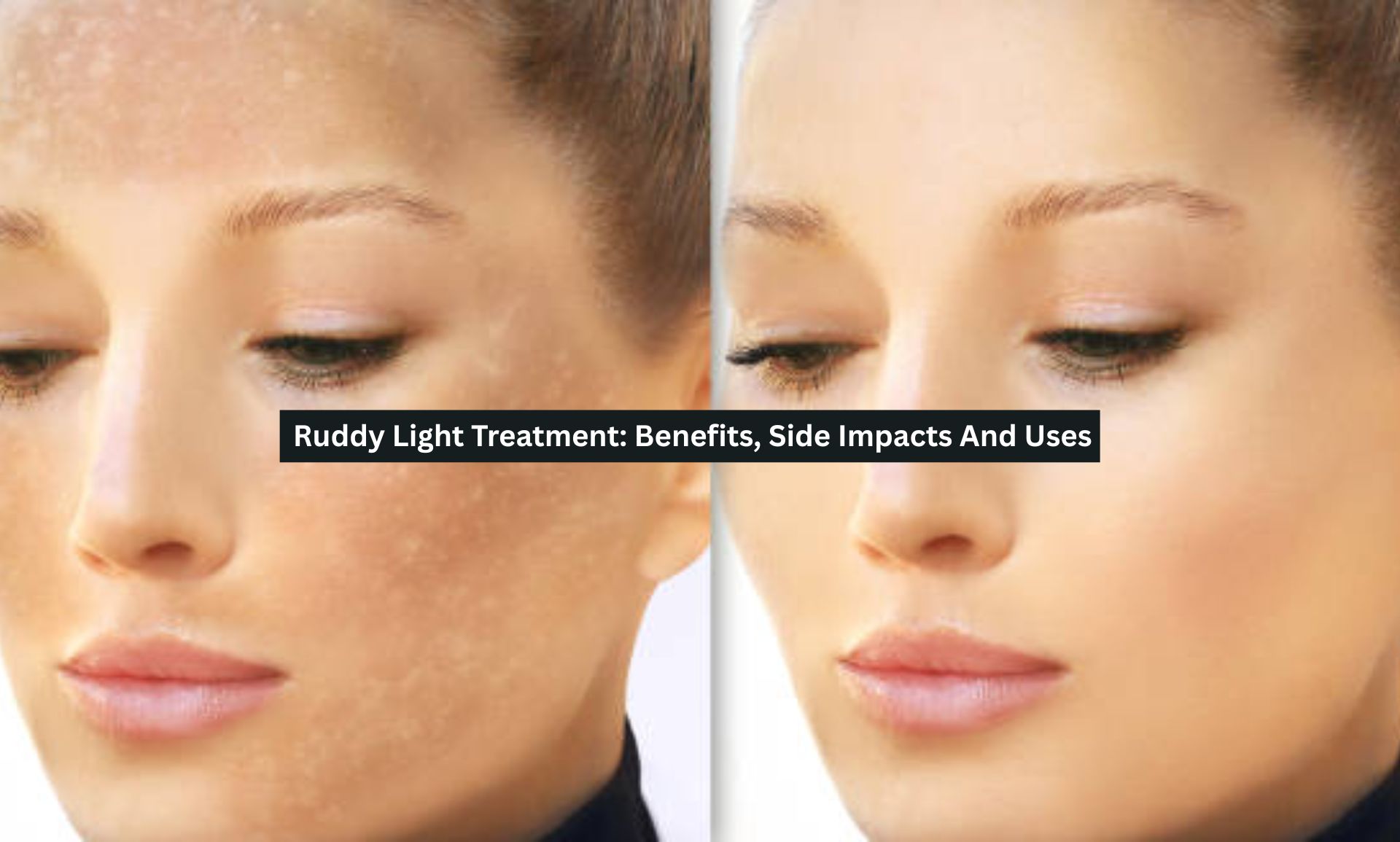 Ruddy Light Treatment: Benefits, Side Impacts And Uses - Nursing Skillset